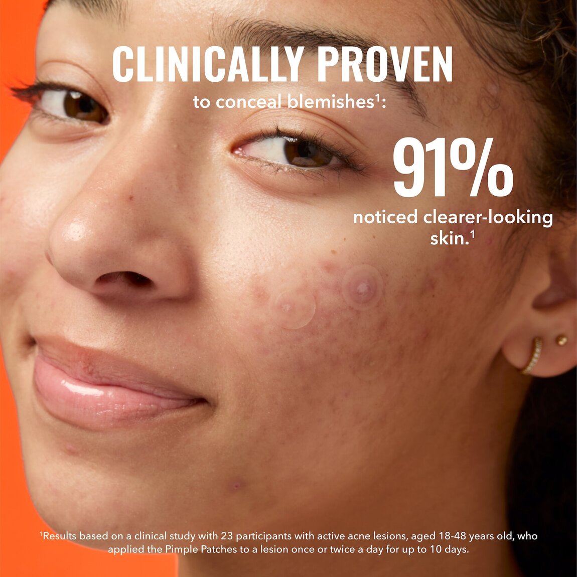 pimple-patches-h1 zb_p.jpg